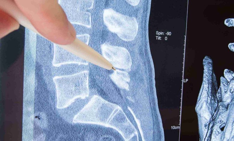 spinal stenosis disability rating