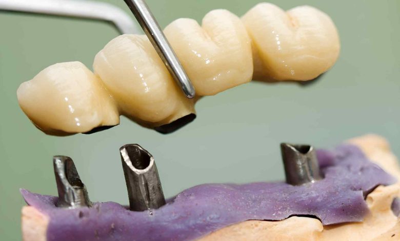 front dental bridge