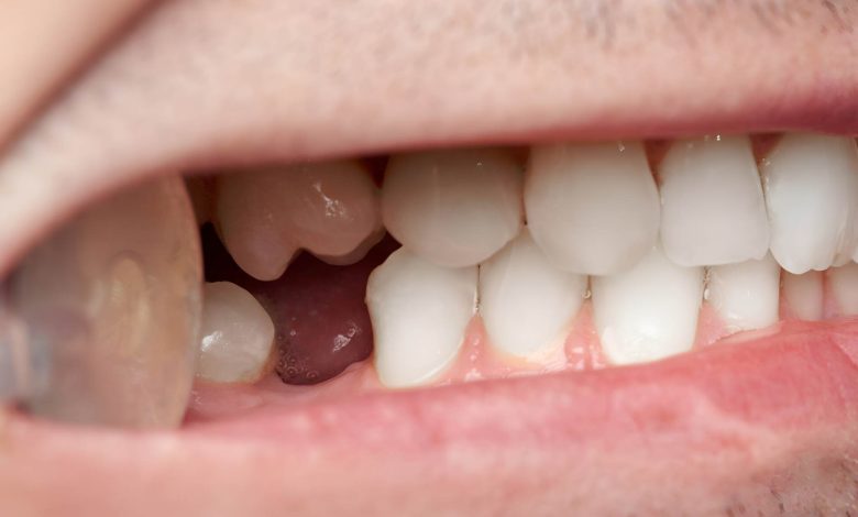 front tooth replacement options